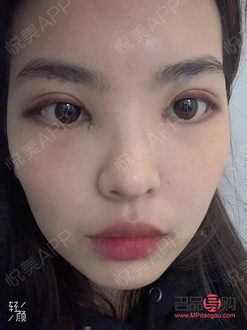 双眼皮手术的眼综合包括哪些项目(双眼皮眼综合手术包括什么项目)