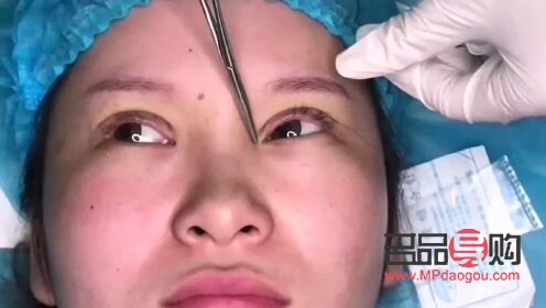 免麻双眼皮是怎么操作的(免麻双眼皮是什么技术) 免麻双眼皮是怎么操作的(免麻双眼皮是什么技术)