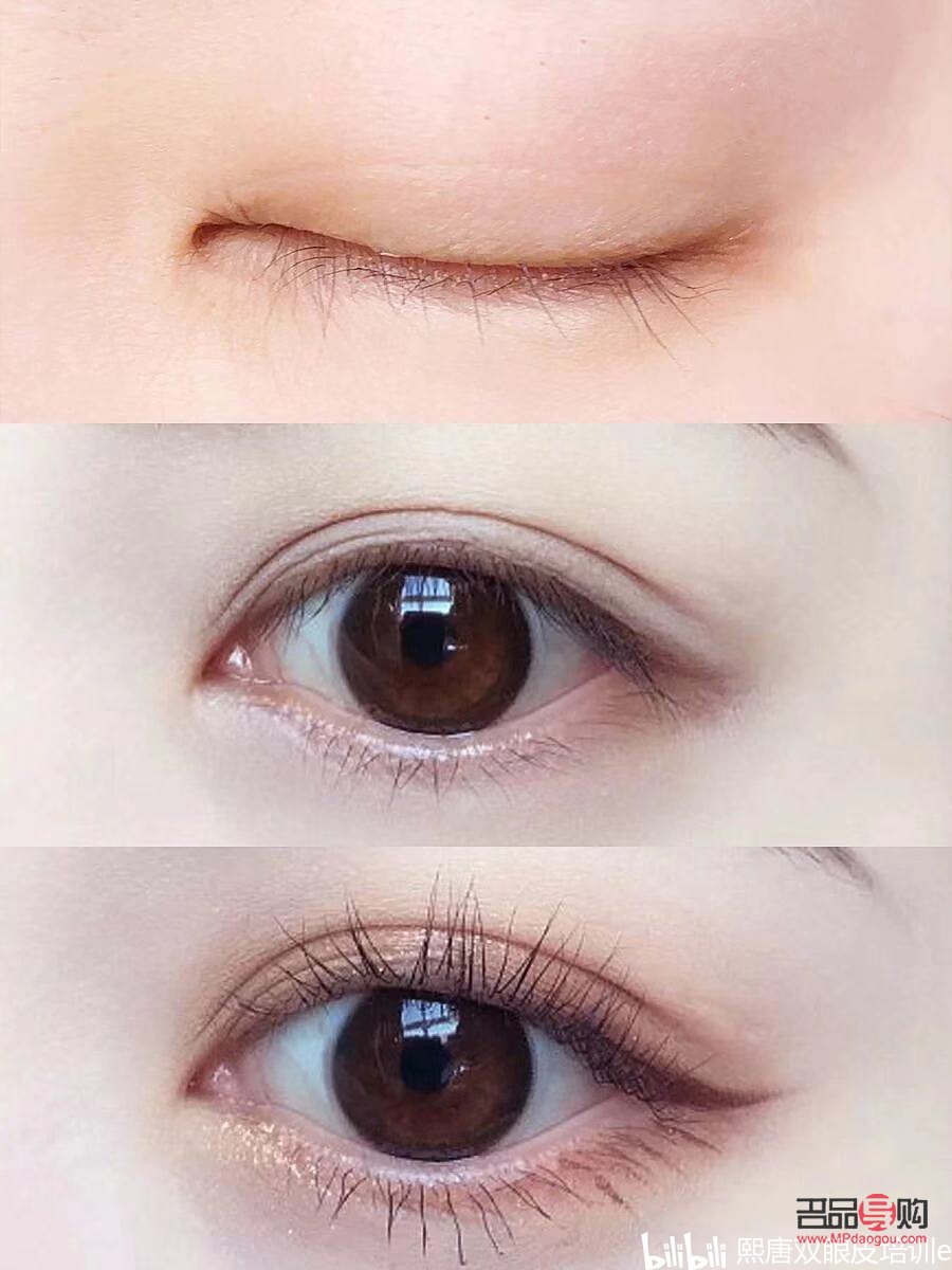 免麻双眼皮是怎么操作的(免麻双眼皮是什么技术)