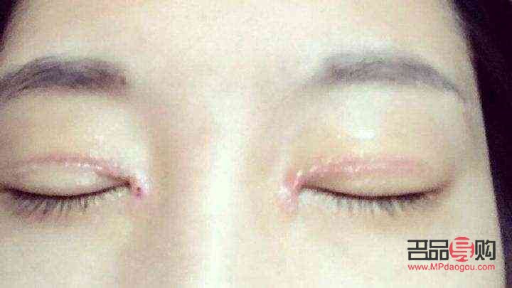 双眼皮增生怎么办(双眼皮增生怎么办多久恢复)