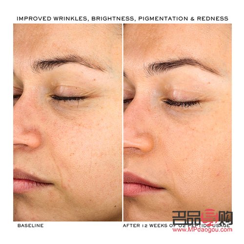 <h3>眼皮消肿后皱巴问题解决方案</h3> <h3>眼皮消肿后皱巴问题解决方案</h3>