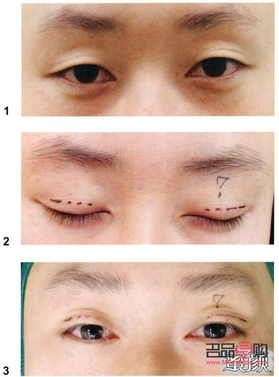 十分钟双眼皮(十分钟双眼皮技术) 十分钟双眼皮(十分钟双眼皮技术)