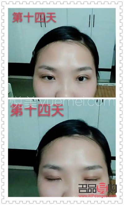 十分钟双眼皮(十分钟双眼皮技术) 十分钟双眼皮(十分钟双眼皮技术)