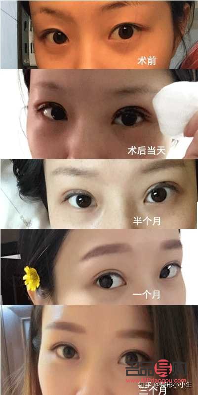 十分钟双眼皮(十分钟双眼皮技术) 十分钟双眼皮(十分钟双眼皮技术)