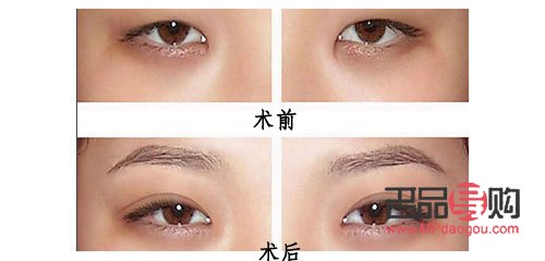 <h3>上眼皮松弛是否可以割双眼皮？</h3>