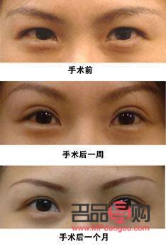 <h3>上眼皮松弛是否可以割双眼皮？</h3>