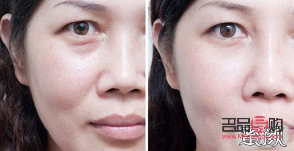 <h3>眼窝凹陷的成因及解析</h3> <h3>眼窝凹陷的成因及解析</h3>