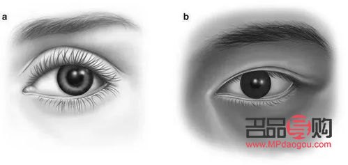 <h3>眼窝凹陷的成因及解析</h3> <h3>眼窝凹陷的成因及解析</h3>
