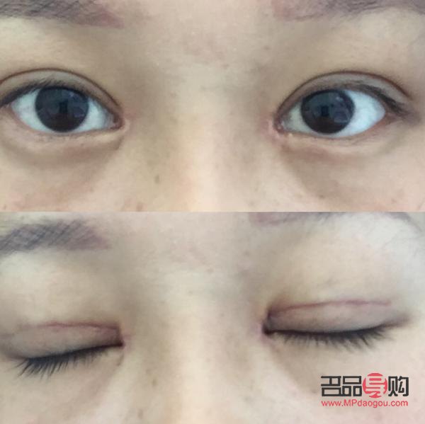 眼部抽脂后眼皮塌了怎么办(眼部抽脂后眼皮塌了怎么办图片) 眼部抽脂后眼皮塌了怎么办(眼部抽脂后眼皮塌了怎么办图片)