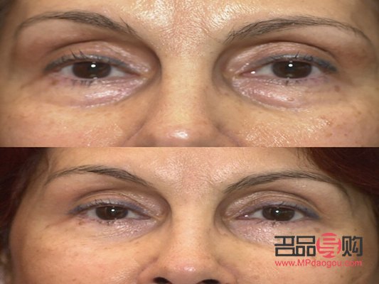 眼部抽脂后眼皮塌了怎么办(眼部抽脂后眼皮塌了怎么办图片) 眼部抽脂后眼皮塌了怎么办(眼部抽脂后眼皮塌了怎么办图片)