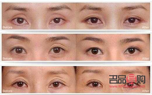 眼部抽脂后眼皮塌了怎么办(眼部抽脂后眼皮塌了怎么办图片) 眼部抽脂后眼皮塌了怎么办(眼部抽脂后眼皮塌了怎么办图片)