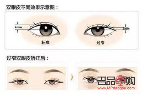 探寻最完美的双眼皮标准