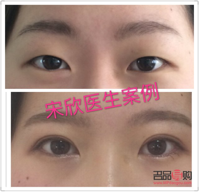 眼角下垂手术视频(眼角下垂手术视频教程)