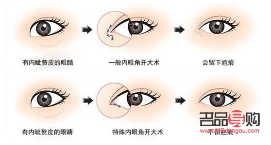 小眼综合一般需要多少钱(小眼综合一般需要多少钱一次)