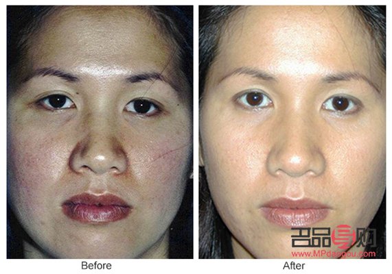 <h3>眼皮抽脂手术前后对比</h3> <h3>眼皮抽脂手术前后对比</h3>