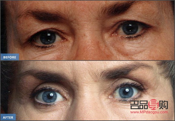 眼皮抽脂手术前后对比