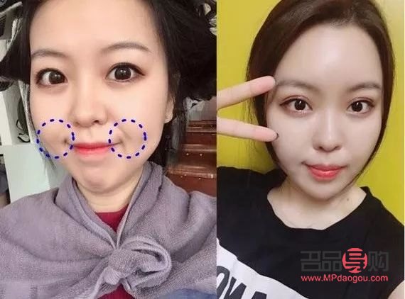 去皱美容针多少钱(美容去皱纹针多少钱一针)