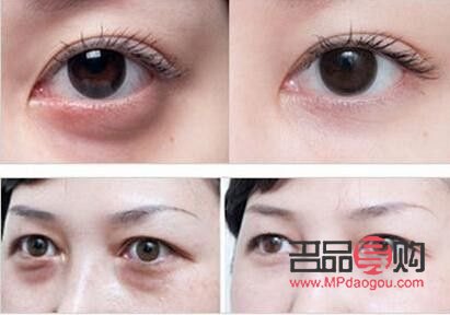 眼袋什么年龄去除最好(眼袋什么年龄去除最好图片)