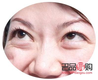 眼袋什么年龄去除最好(眼袋什么年龄去除最好图片)