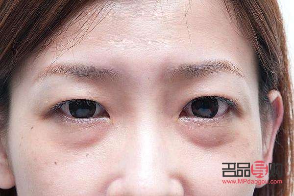 眼袋什么年龄去除最好(眼袋什么年龄去除最好图片)