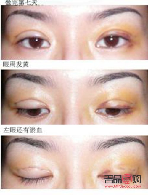 大眼综合真实恢复期图片(大眼综合的恢复过程) 大眼综合真实恢复期图片(大眼综合的恢复过程)