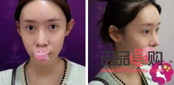 大眼综合真实恢复期图片(大眼综合的恢复过程) 大眼综合真实恢复期图片(大眼综合的恢复过程)