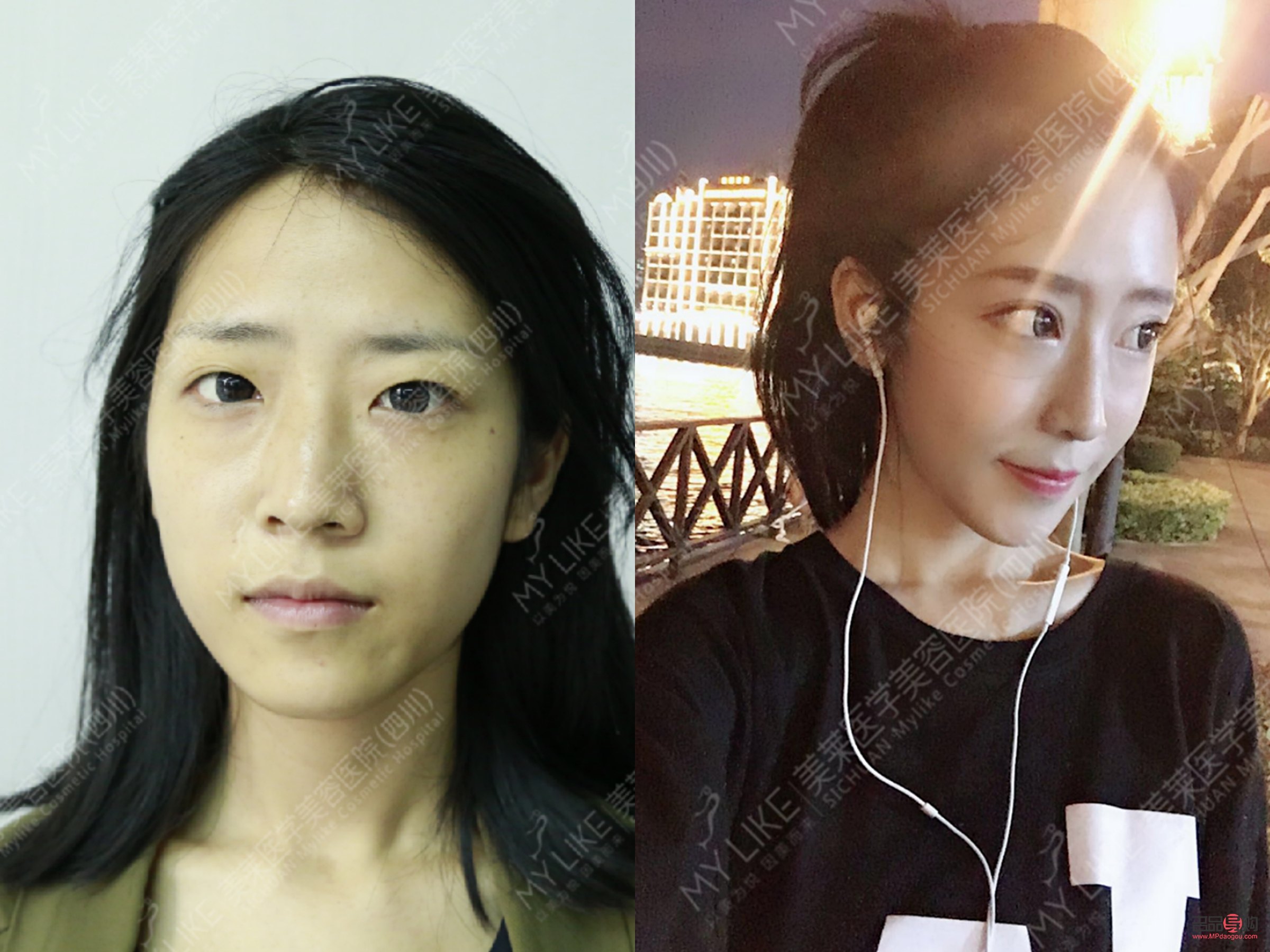 <h3>双眼皮二次手术:需求、风险与考量</h3> <h3>双眼皮二次手术:需求、风险与考量</h3>