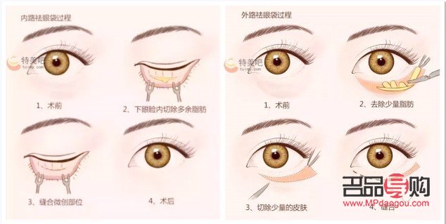 <h3>探究眼袋形成之谜:成因、影响与解决方案</h3> <h3>探究眼袋形成之谜:成因、影响与解决方案</h3>