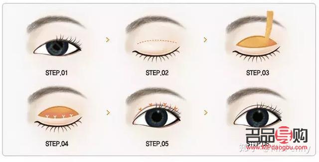 <h3>双眼皮手术初探：首次尝试者指南</h3>