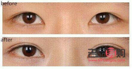 <h3>双眼皮手术前后惊艳对比:重塑电眼魅力</h3> <h3>双眼皮手术前后惊艳对比:重塑电眼魅力</h3>
