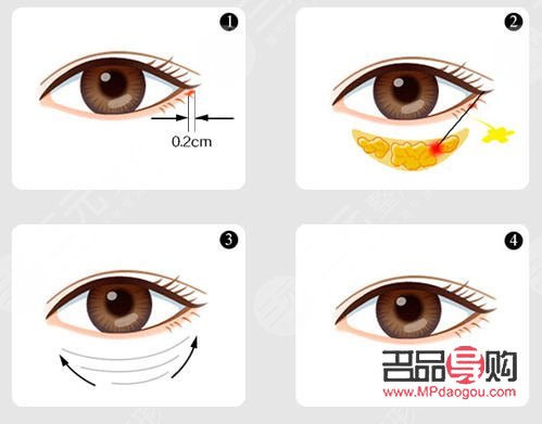 <h3>去眼袋手术前后注意事项全解析</h3>