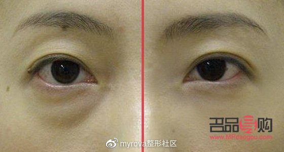 去眼袋手术前后注意事项全解析