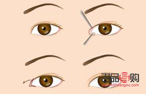 什么季节去割双眼皮最好(什么季节去割双眼皮最好呢) 什么季节去割双眼皮最好(什么季节去割双眼皮最好呢)