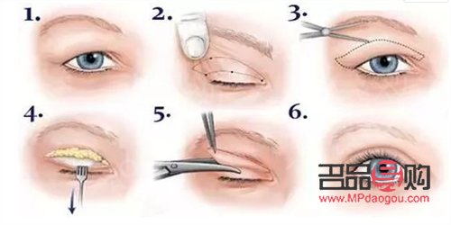 什么季节去割双眼皮最好(什么季节去割双眼皮最好呢) 什么季节去割双眼皮最好(什么季节去割双眼皮最好呢)