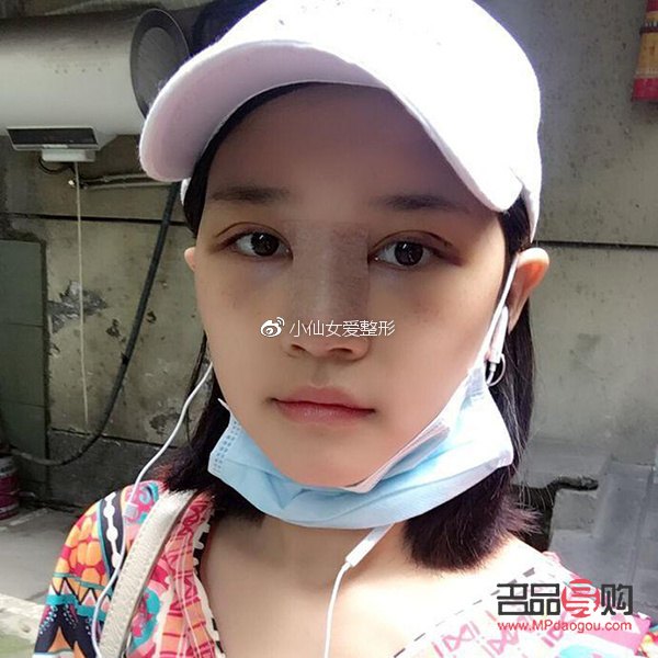 <h3>探寻双眼皮手术之路：哪种方式恢复迅速又自然？</h3>