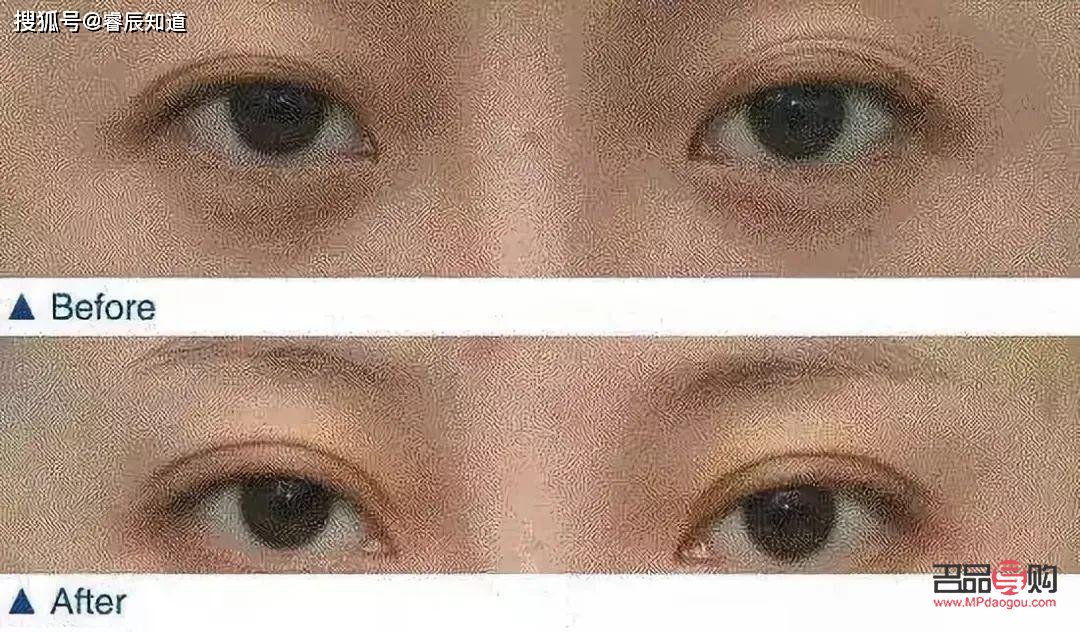 双眼皮变成好多层眼皮是什么情况(双眼皮变成好多层眼皮是什么情况图片) 双眼皮变成好多层眼皮是什么情况(双眼皮变成好多层眼皮是什么情况图片)