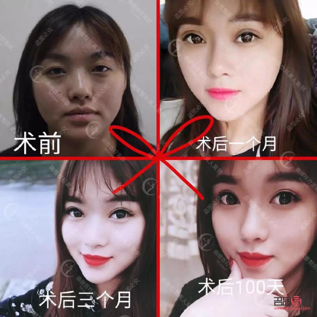 双眼皮变成好多层眼皮是什么情况(双眼皮变成好多层眼皮是什么情况图片) 双眼皮变成好多层眼皮是什么情况(双眼皮变成好多层眼皮是什么情况图片)