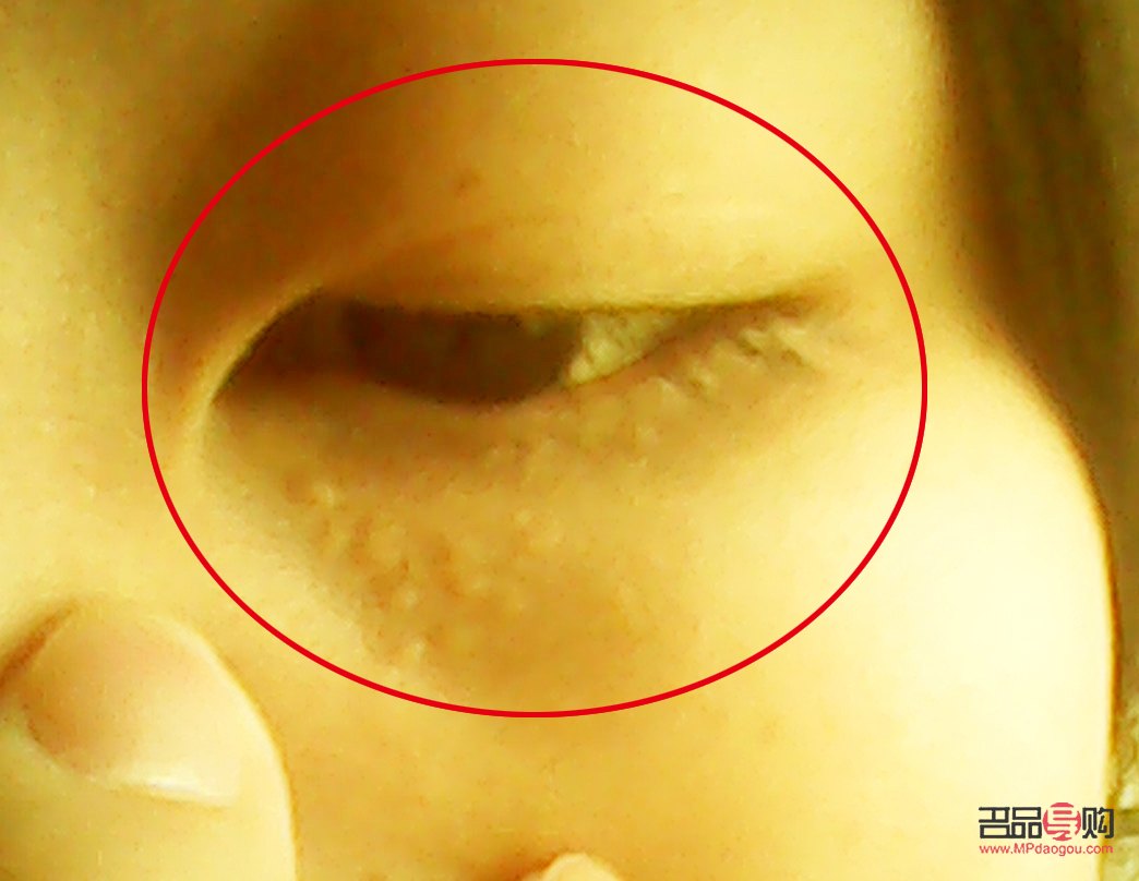 眼周脂肪粒去除小窍门大揭秘