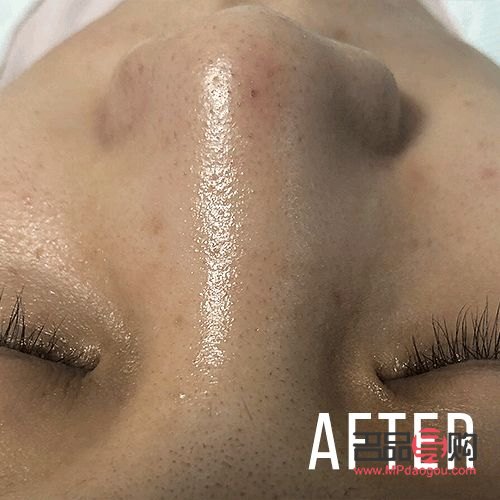 美容去黑头多少钱(美容去黑头多少钱一次鼻子) 美容去黑头多少钱(美容去黑头多少钱一次鼻子)