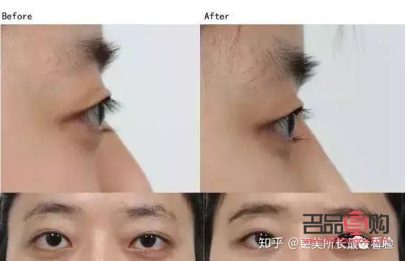 凸眼球矫正手术多少钱(凸眼球矫正手术多少钱)