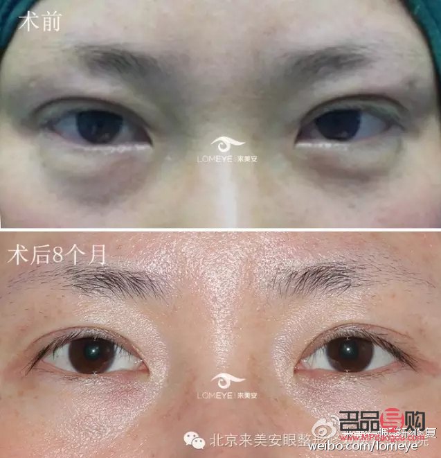 <h3>双眼皮眼形分类大全,你属于哪一种?</h3> <h3>双眼皮眼形分类大全,你属于哪一种?</h3>