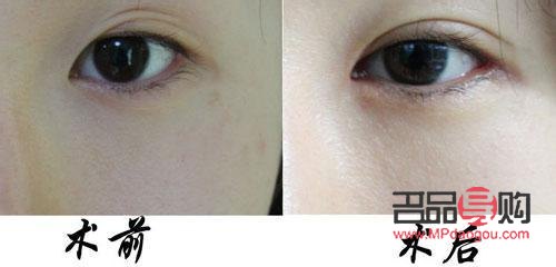 双眼皮类型全解析：图解各种双眼皮形态