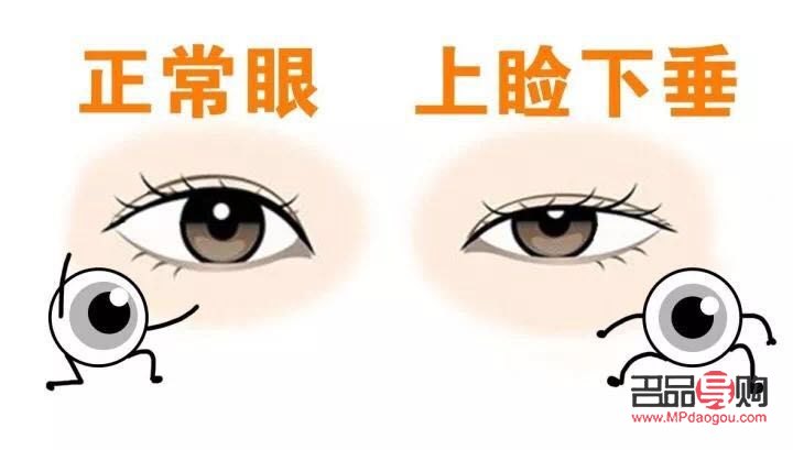 近视与上眼皮耷拉下来的关联及应对措施 近视与上眼皮耷拉下来的关联及应对措施