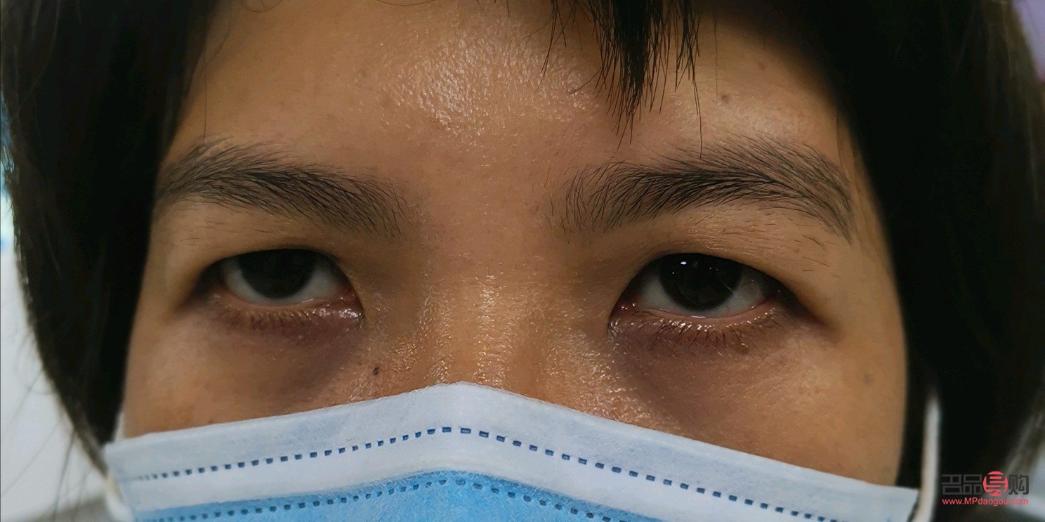 近视与上眼皮耷拉下来的关联及应对措施 近视与上眼皮耷拉下来的关联及应对措施