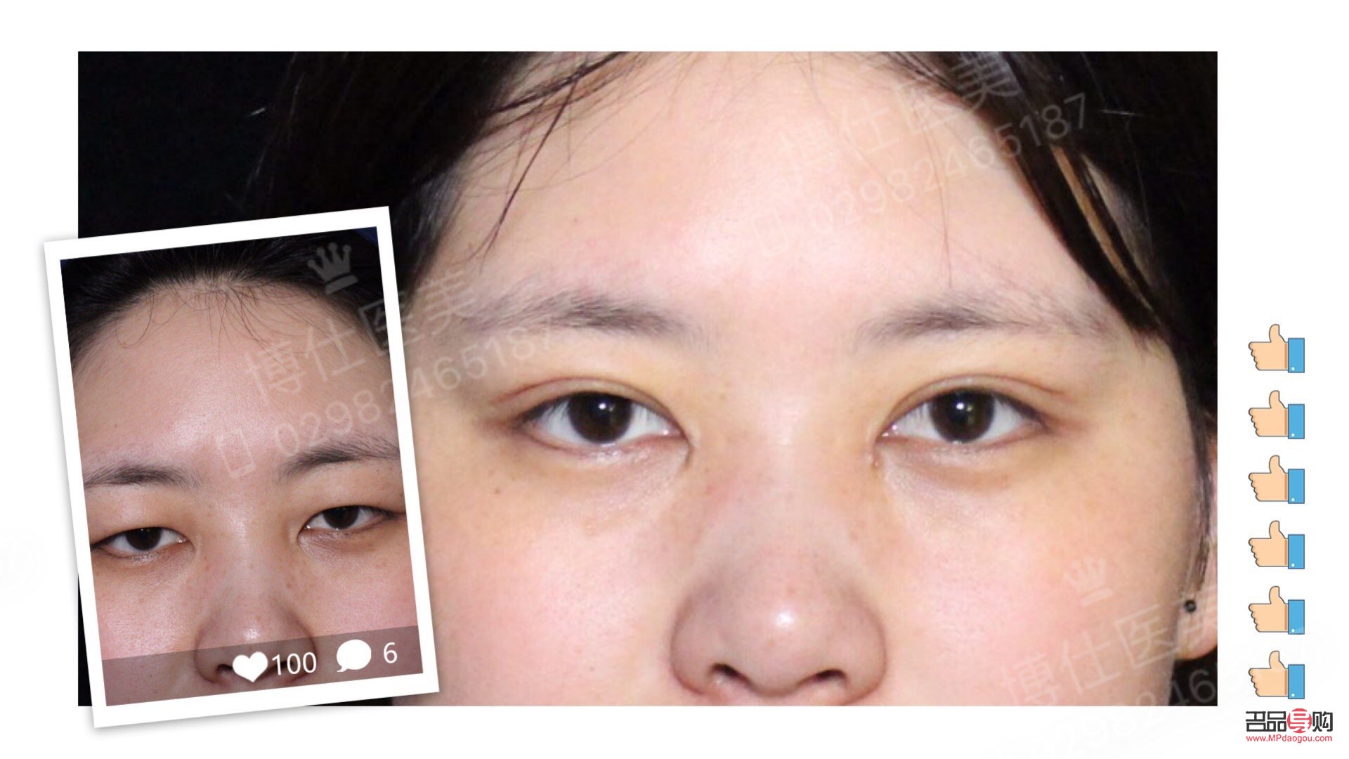 <h3>开扇双眼皮是什么意思？</h3>