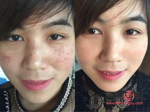 美容祛斑好吗(美容祛斑好吗知乎)