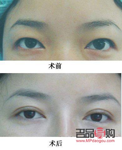 平行双眼皮图片 真人(平行双眼皮图片 真人图)