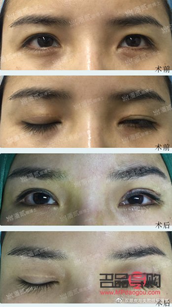 提肌双眼皮手术可能带来的后遗症