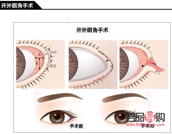 眼角开的有点大了之后还能修复吗(眼角开的有点大了之后还能修复吗图片)