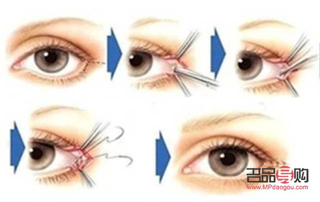 眼角开的有点大了之后还能修复吗(眼角开的有点大了之后还能修复吗图片)